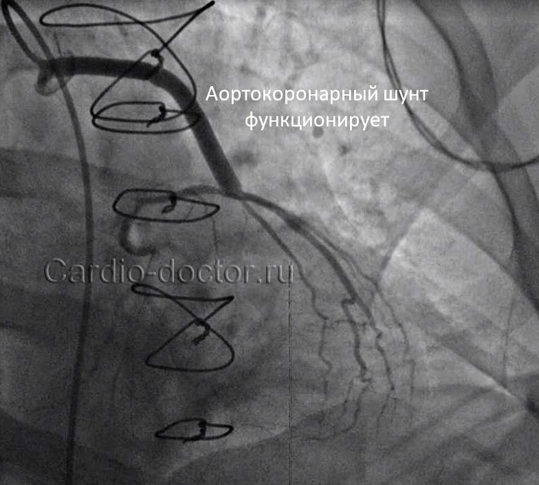 Immediate results of off-pump coronary artery bypass grafting